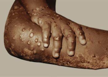 NO RESTRICTIONS ON ENTRY OF PERSONS OR IMPORTED GOODS FROM ANY COUNTRY AT THIS TIME DUE TO MONKEYPOX