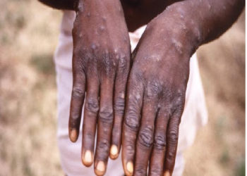 MINISTRY OF HEALTH PRESS RELEASE RE: NO CASES OF MONKEYPOX IN THE FEDERATION OF ST. KITTS & NEVIS